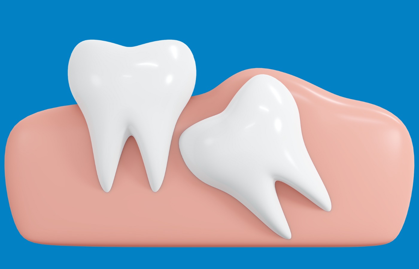 wisdom teeth removall